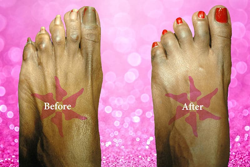 Hammertoe Correction before and after treatment