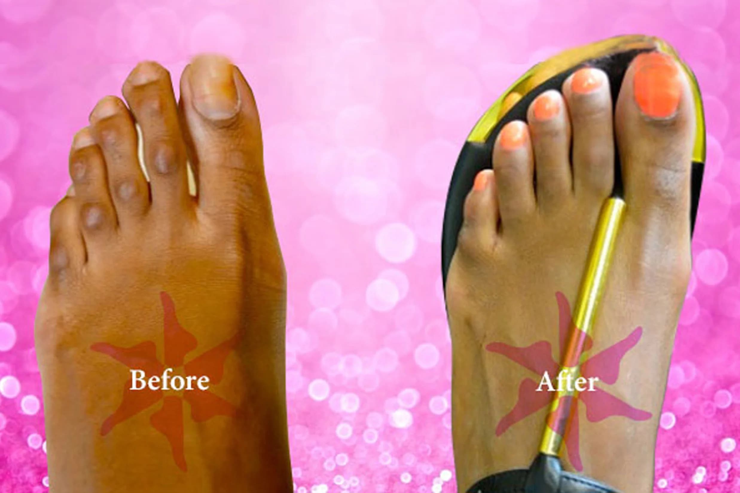 Hammertoe + Corn Removal before and after treatment