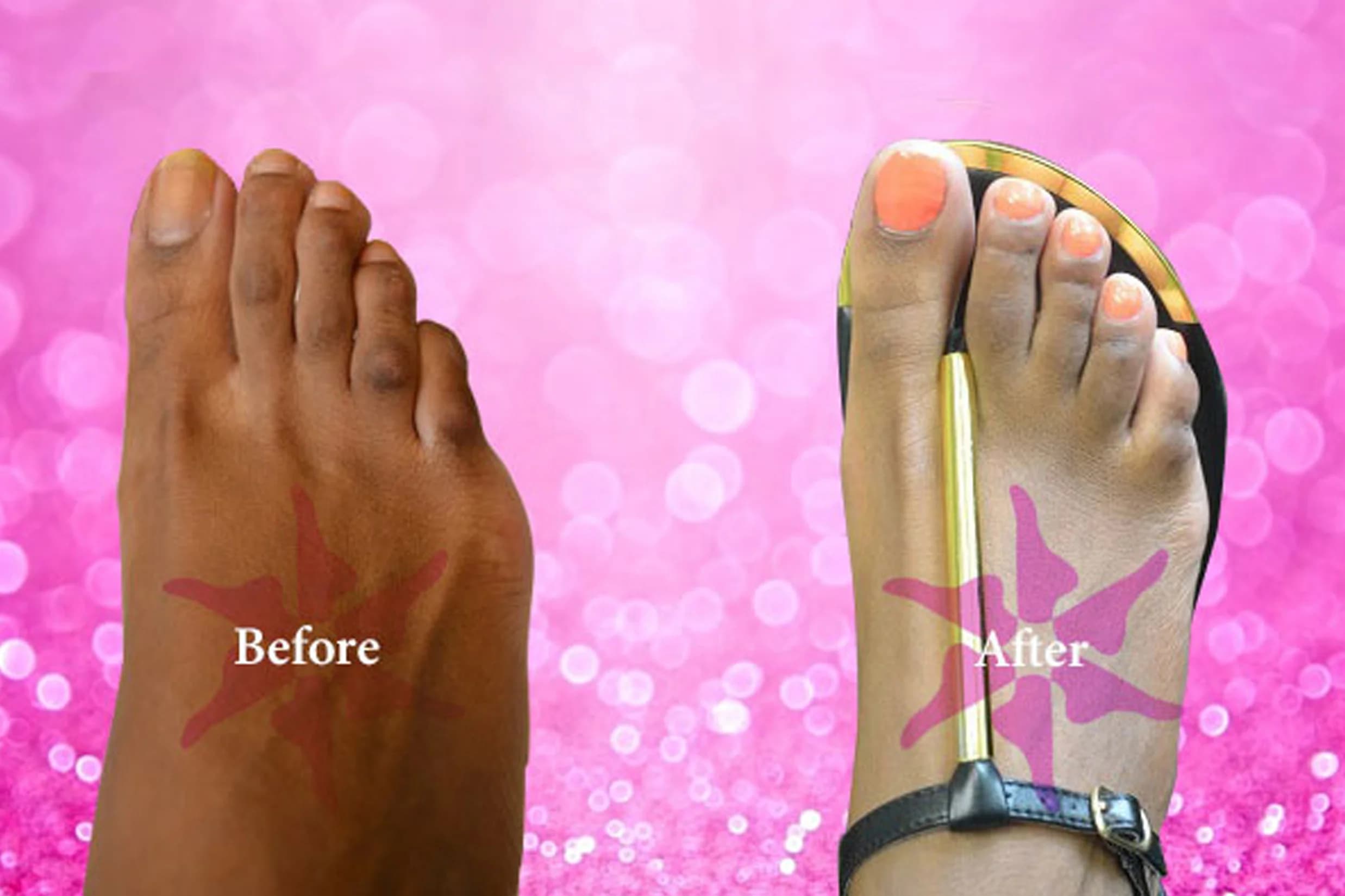 Hammertoe + Corn Removal before and after treatment