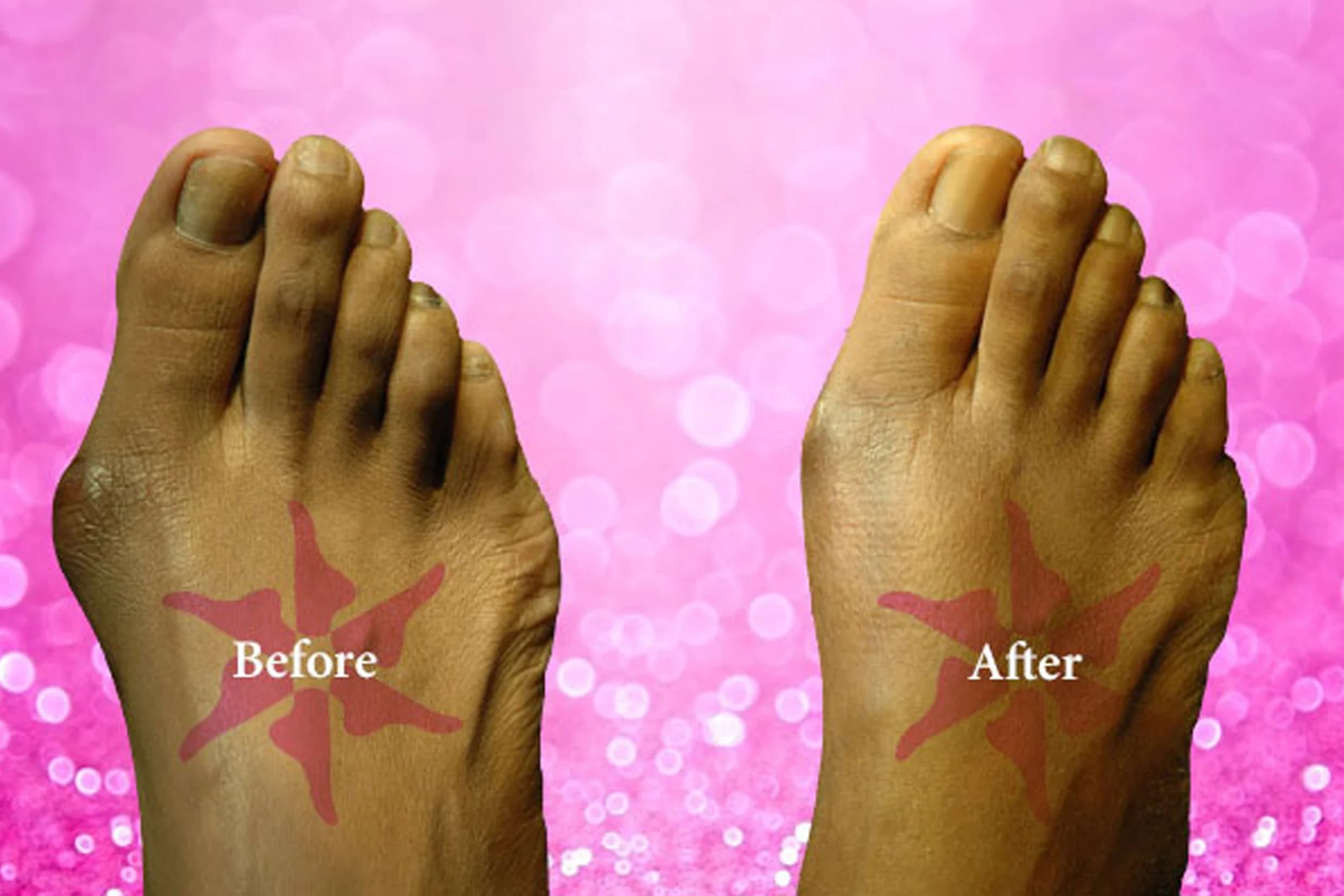 Bunionectomy before and after treatment