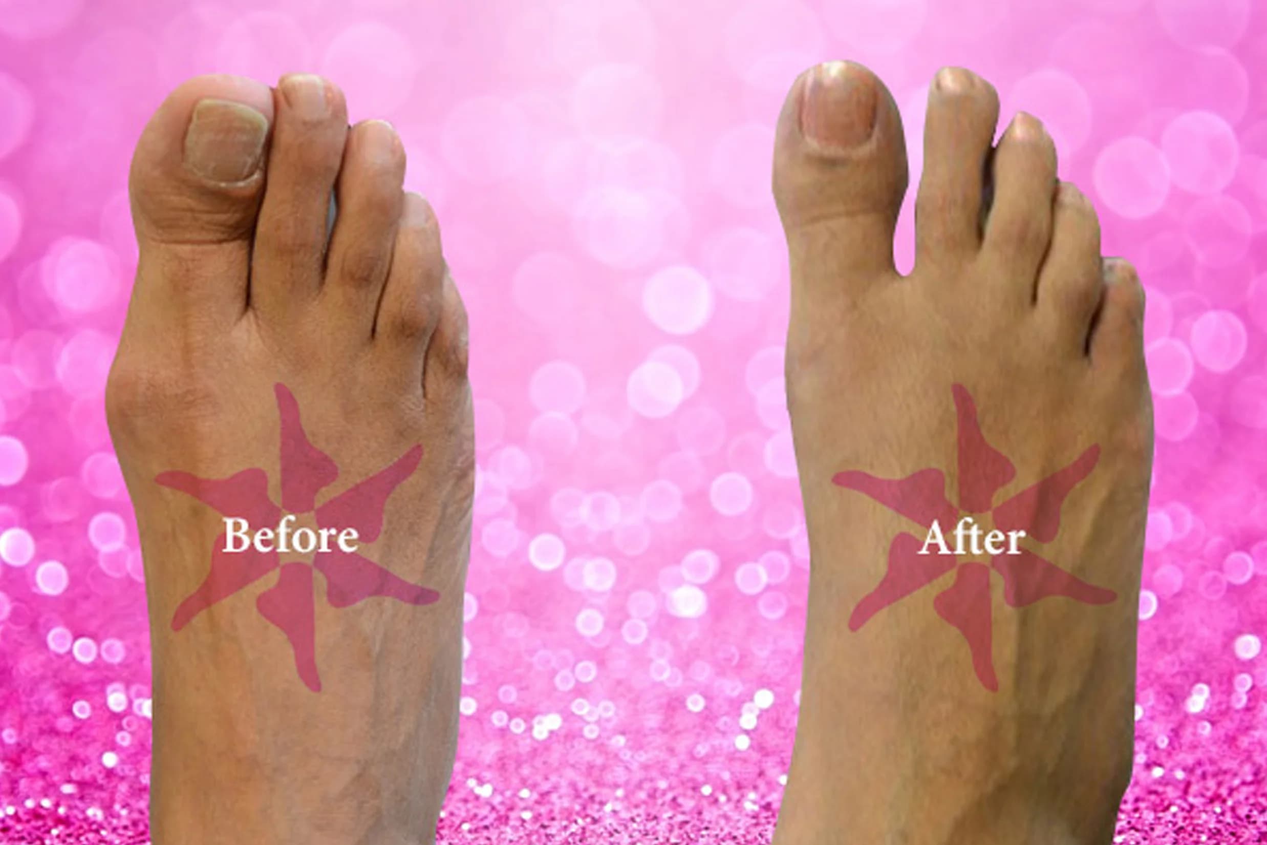 Bunionectomy + Hammertoe before and after treatment
