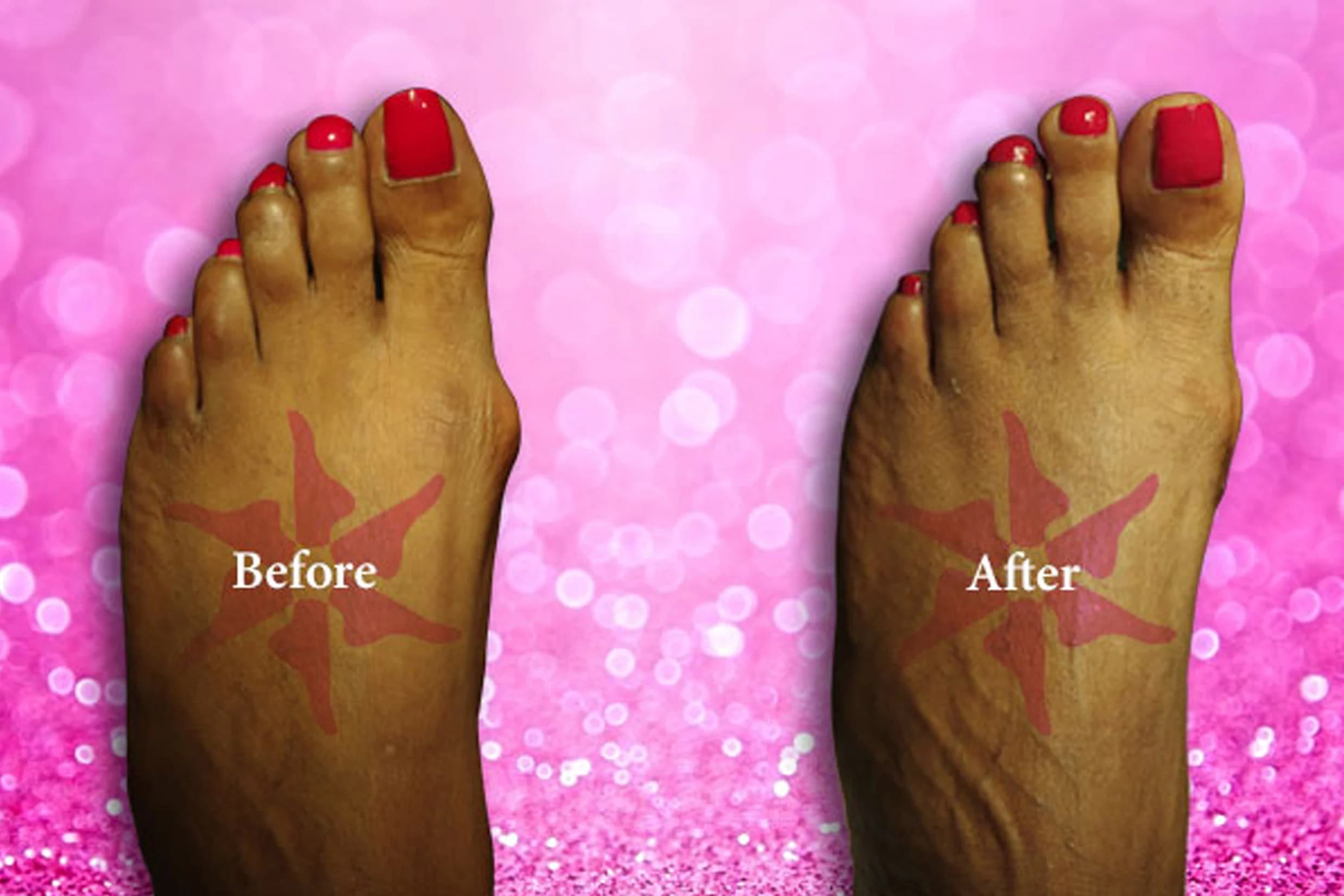 Bunionectomy + Hammertoe before and after treatment