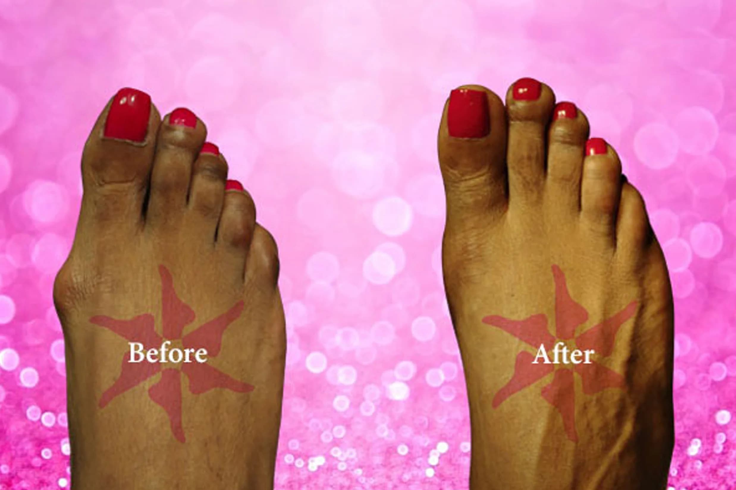 Bunionectomy before and after treatment