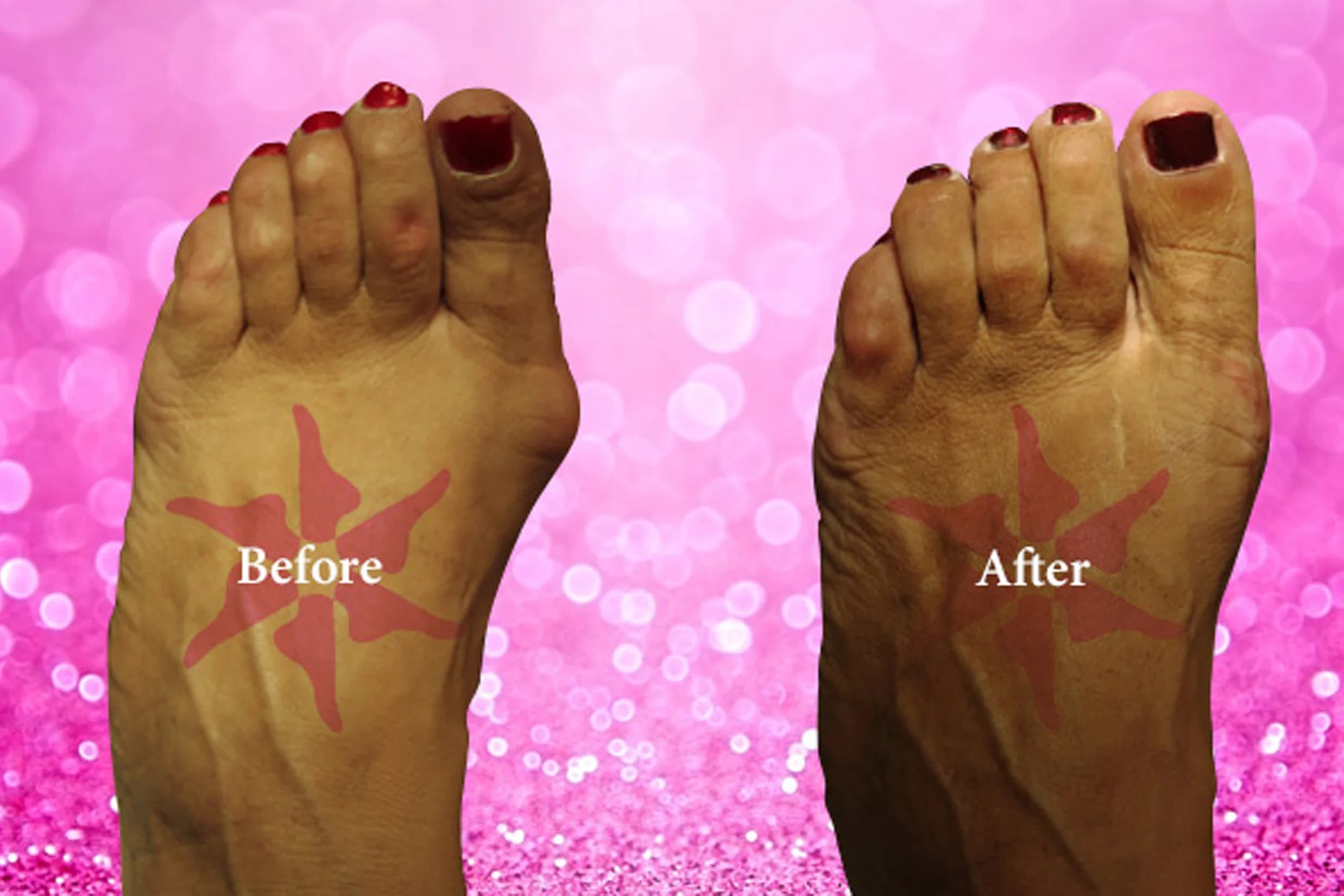 Bunionectomy + Hammertoe before and after treatment
