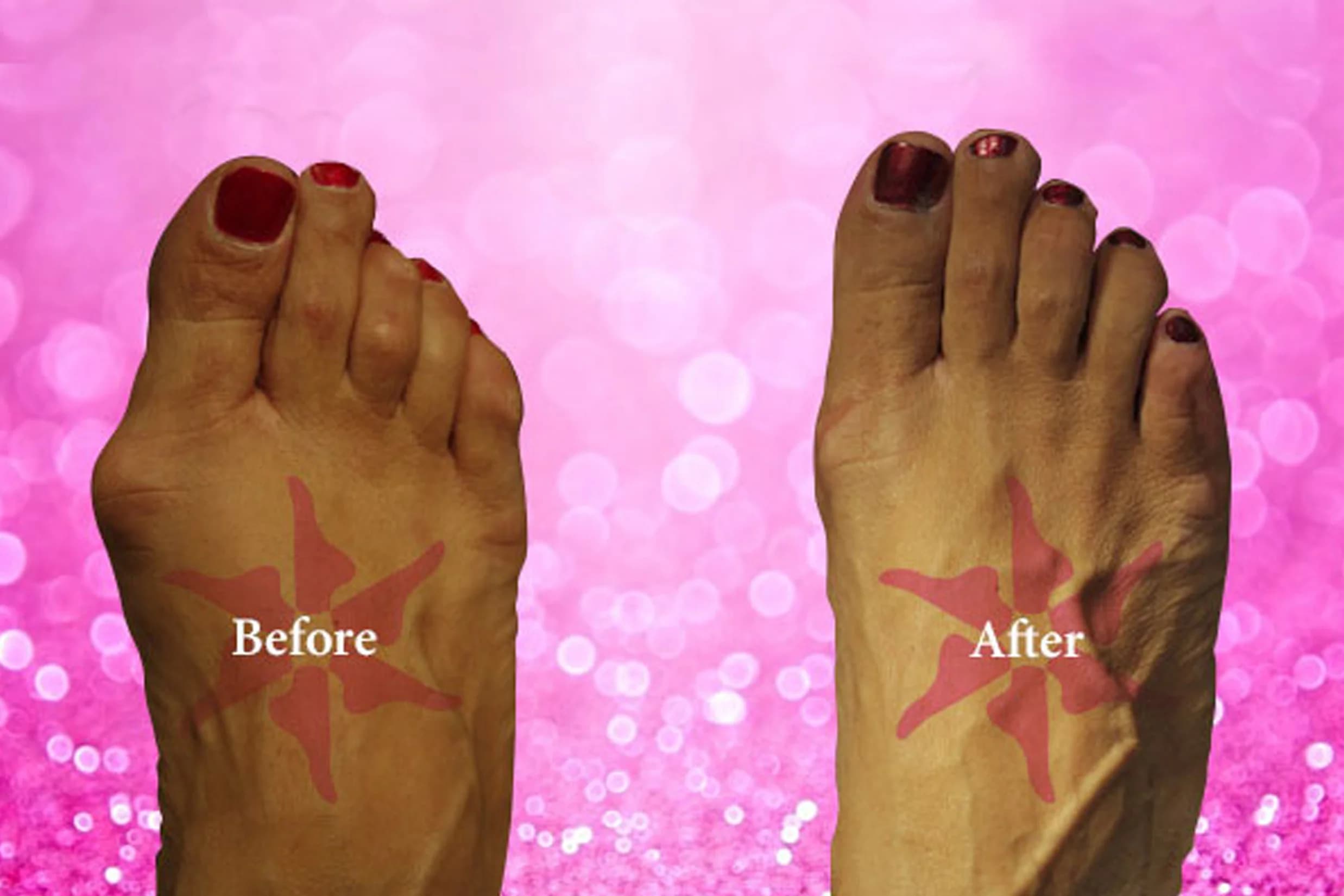 Bunionectomy + Hammertoe before and after treatment