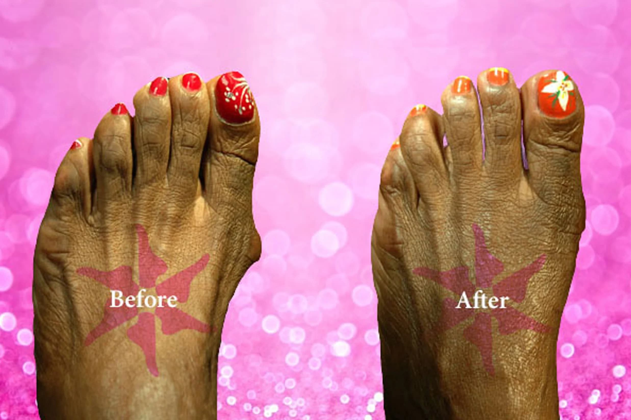 Bunionectomy before and after treatment