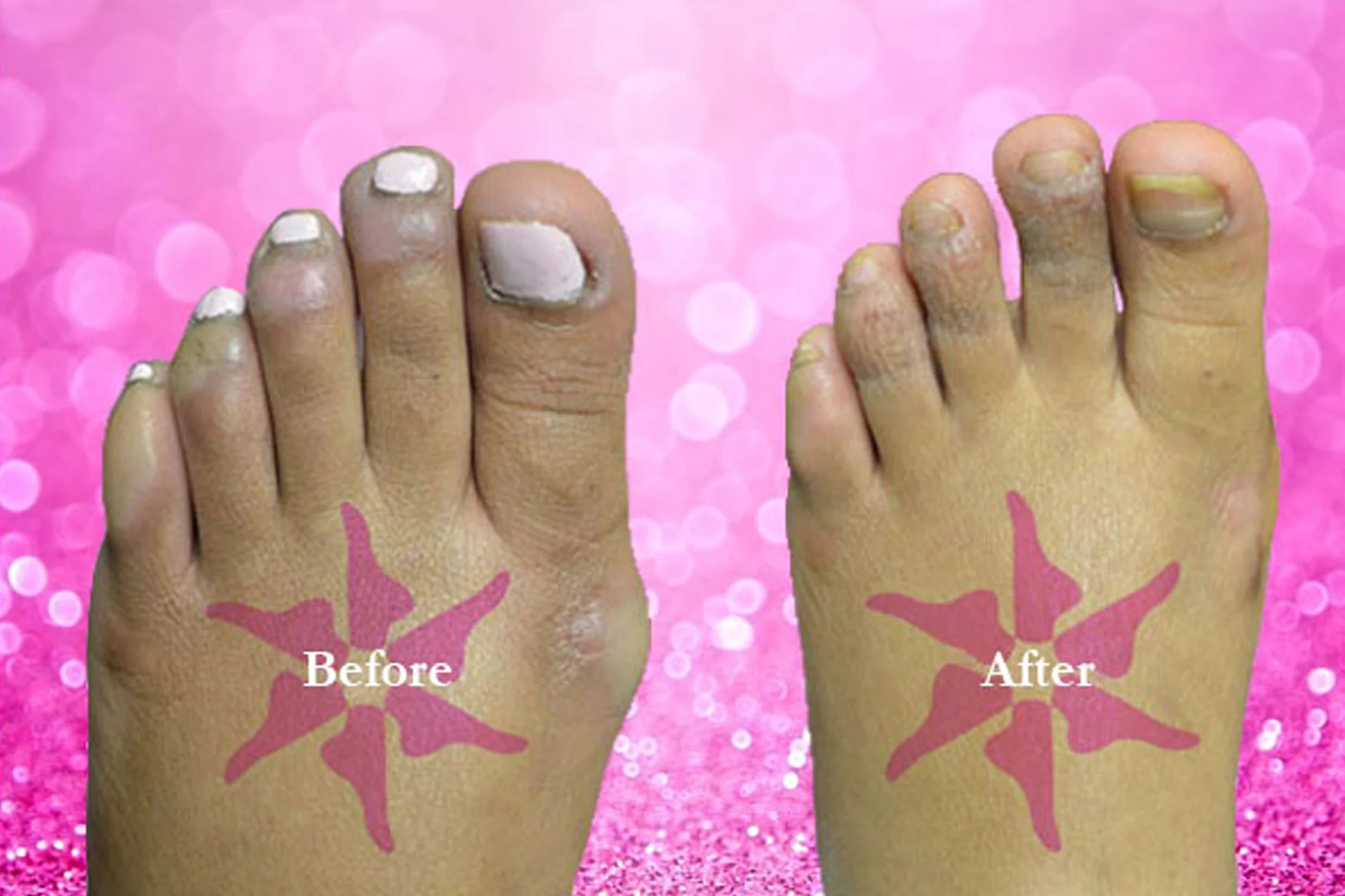 Hammertoe + Corn Removal before and after treatment
