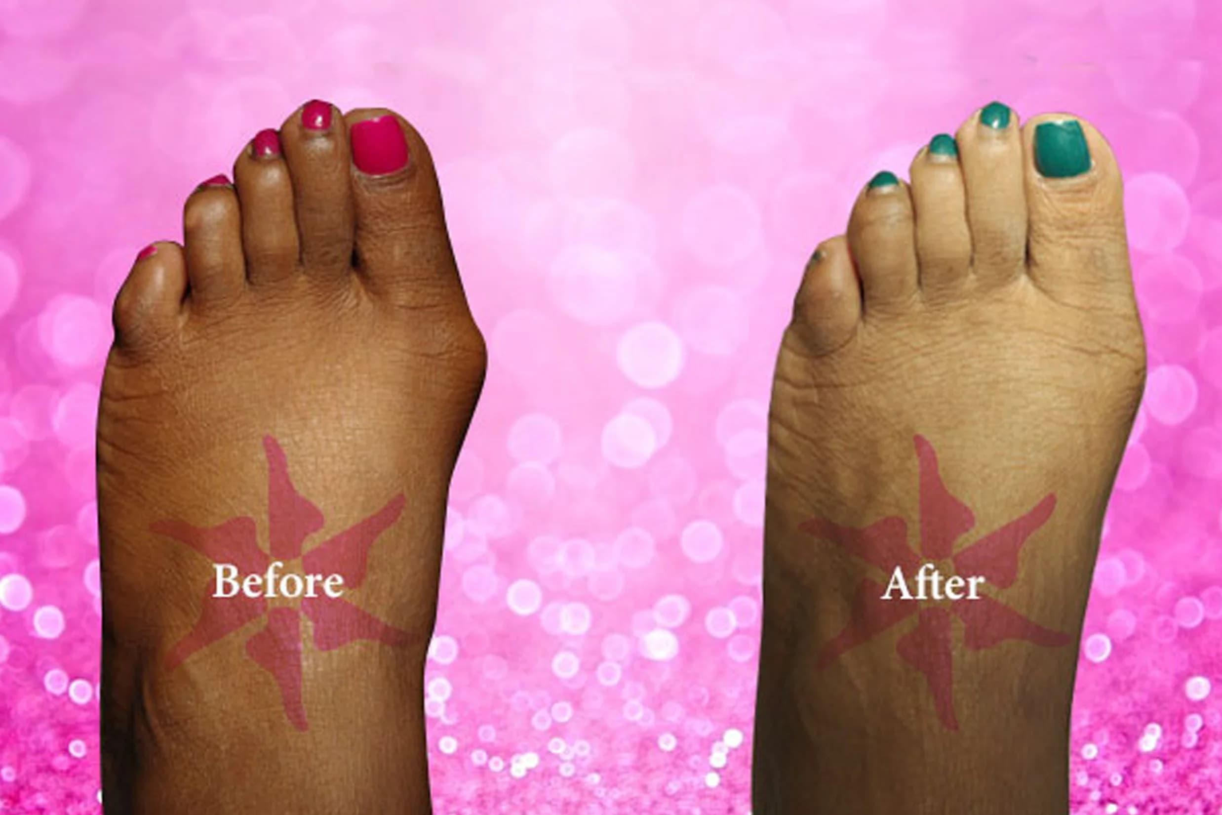 Bunionectomy + Hammertoe before and after treatment
