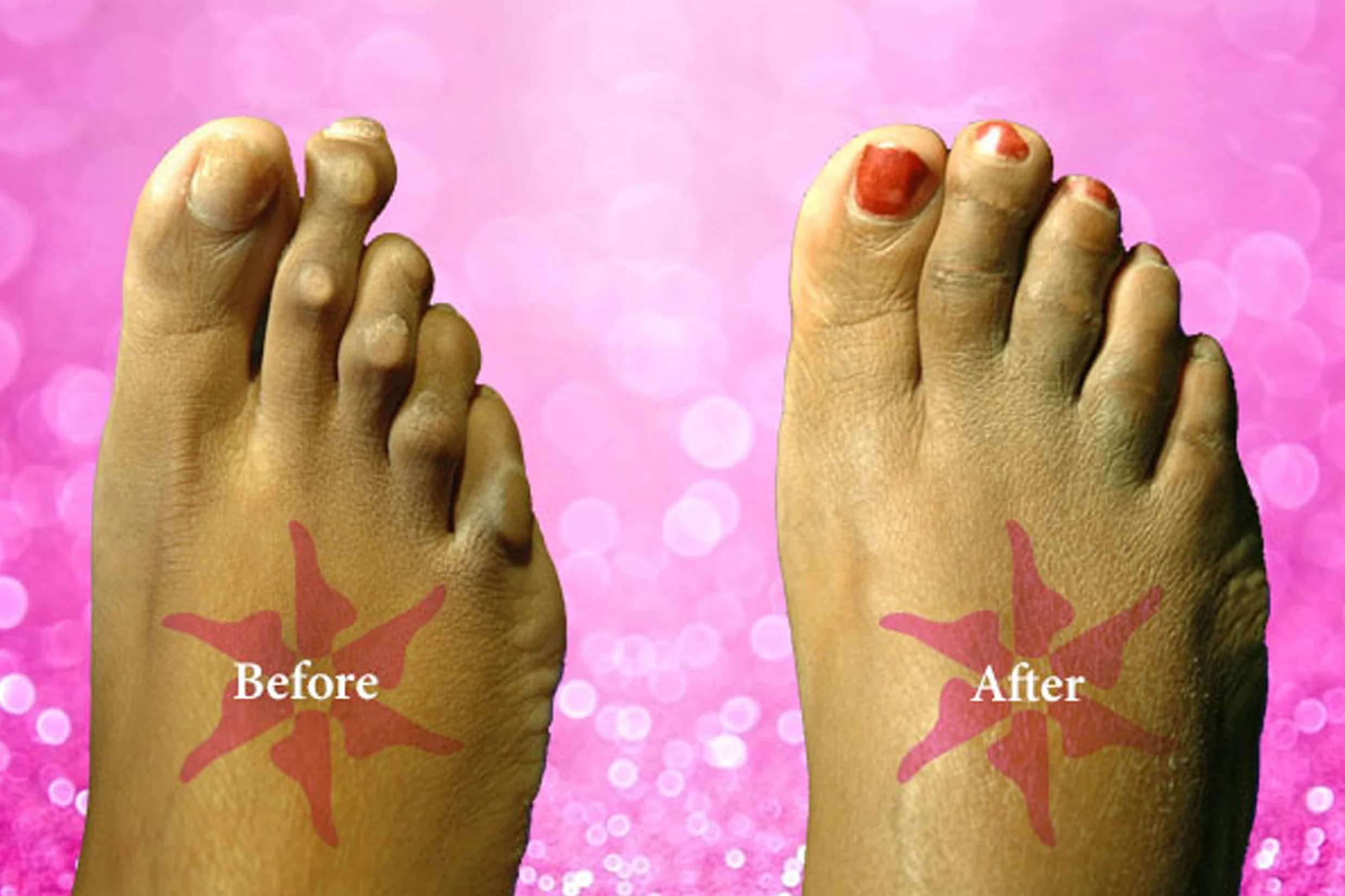 Hammertoe + Corn Removal before and after treatment