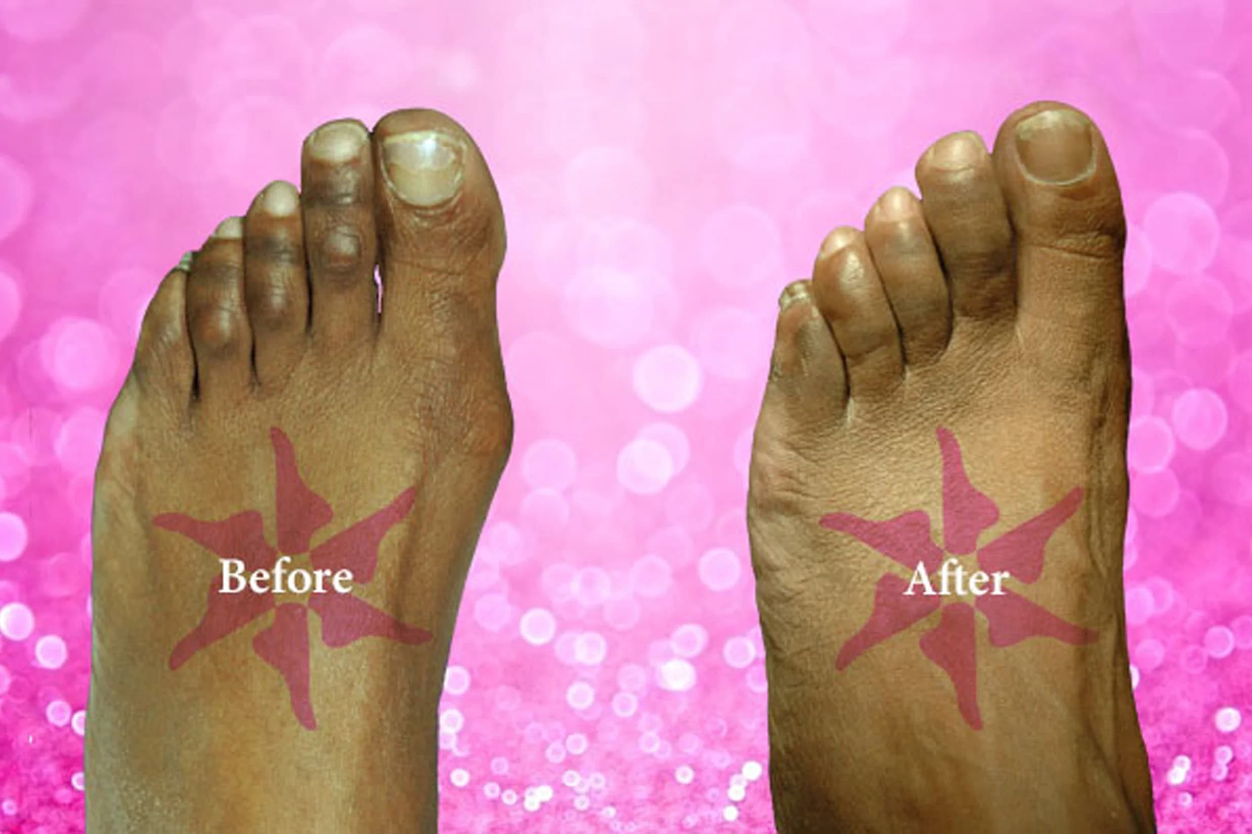 Bunionectomy + Hammertoe before and after treatment