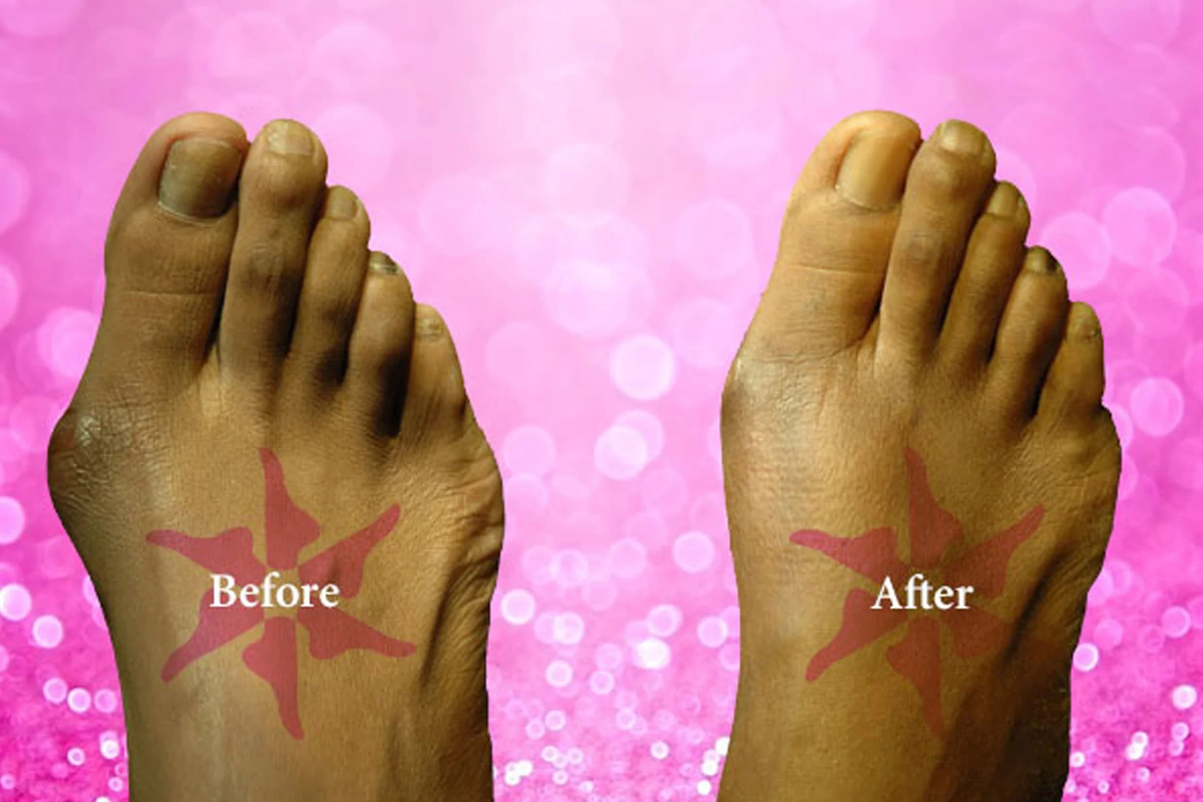 Bunionectomy before and after treatment