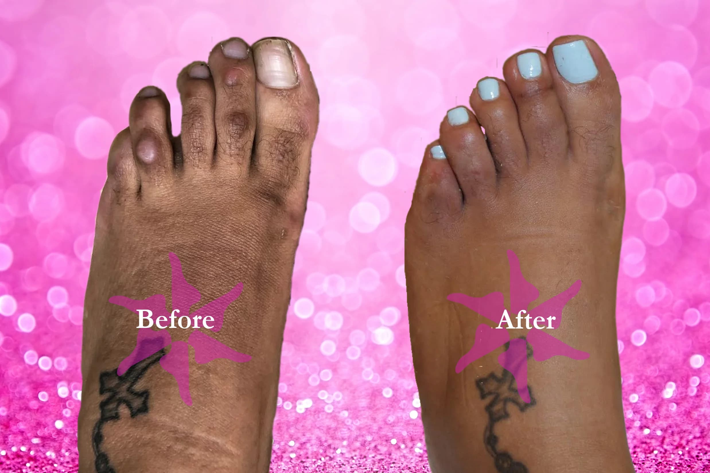 Hammertoe Correction before and after treatment